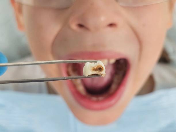 Best Emergency Wisdom Teeth Removal in Dilley, TX